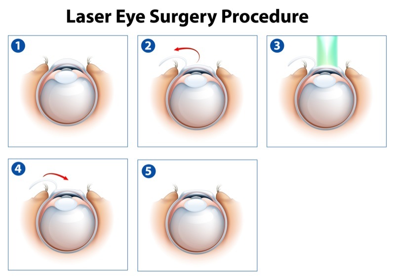 LASIK procedure step-by-step