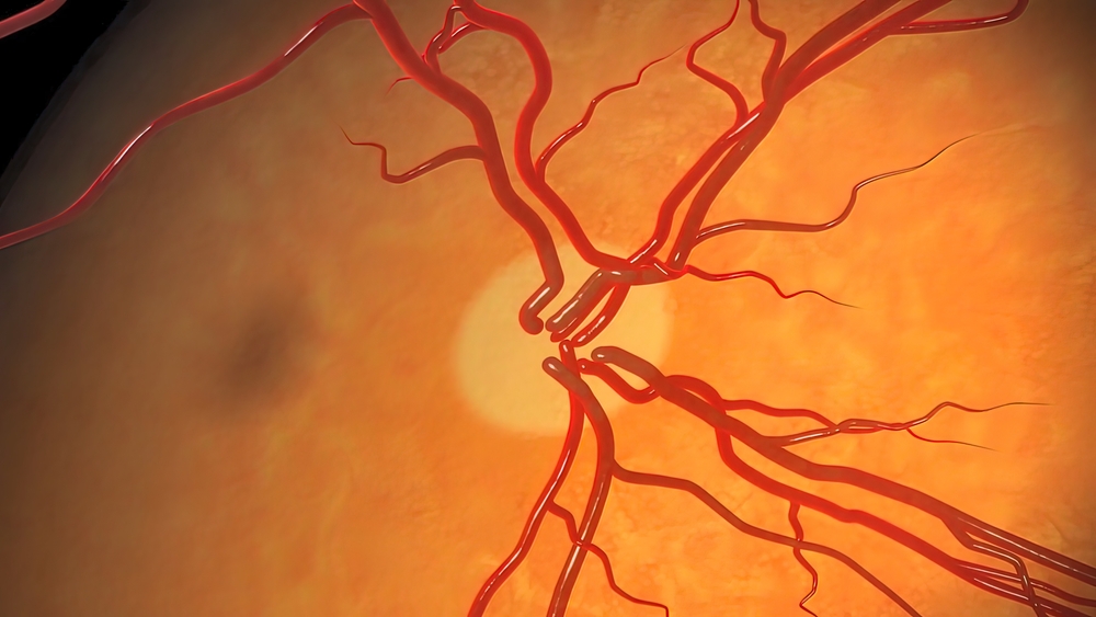 Optic Nerve Damage