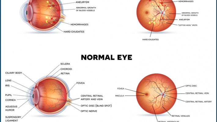 Diabetic Eye Problems