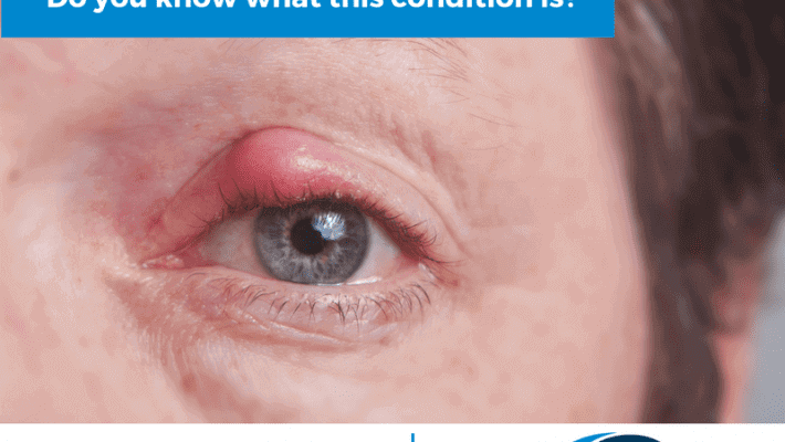Chalazion Treatment