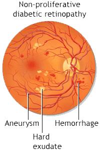 Non-Proliferative Diabetic Retinopathy
