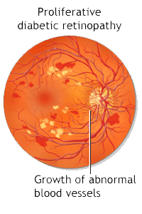 Proliferative Diabetic Retinopathy