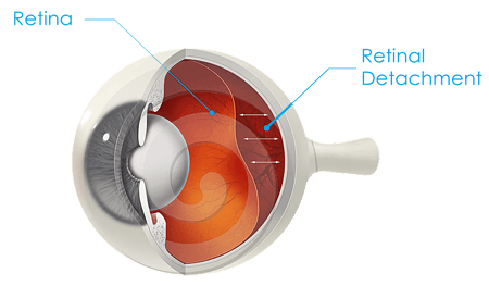 Retinal Detachment Diagram